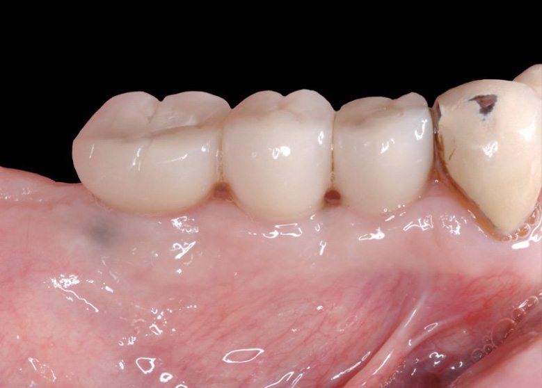 Row of three replacement teeth attached to dental implant posts
