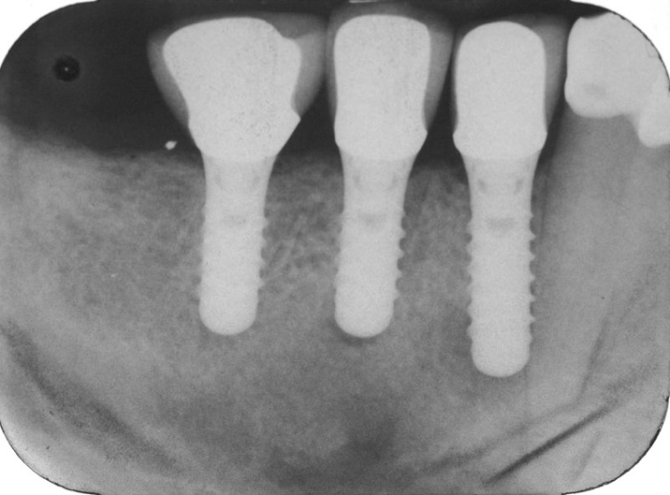 X-ray of smile after dental implant tooth replacement is completed