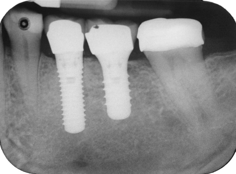 X-ray of smile after tooth replacement