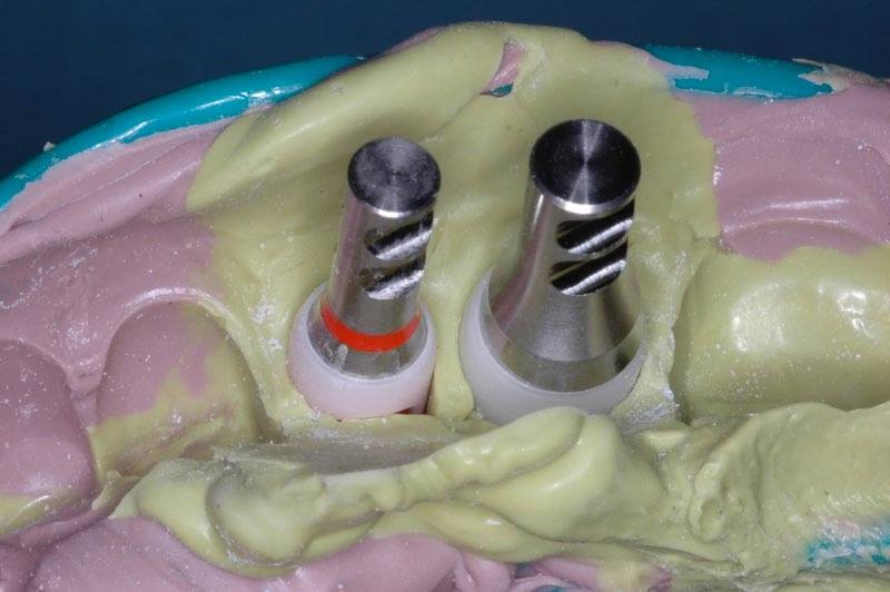Dental implant analogs in place during bite impression