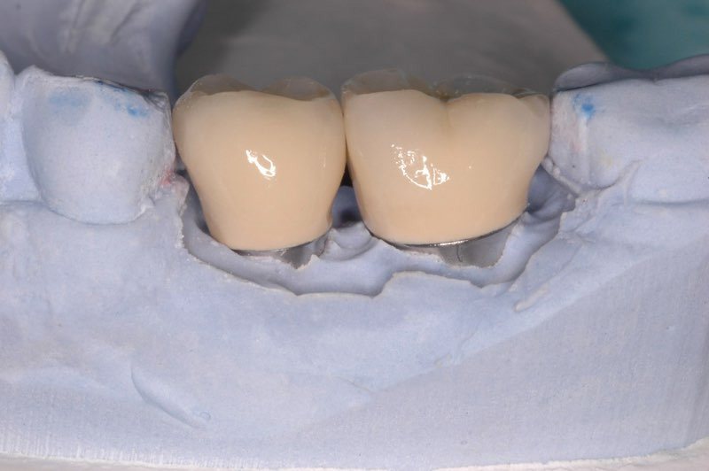 Dental crowns in place on smile model in dental lab