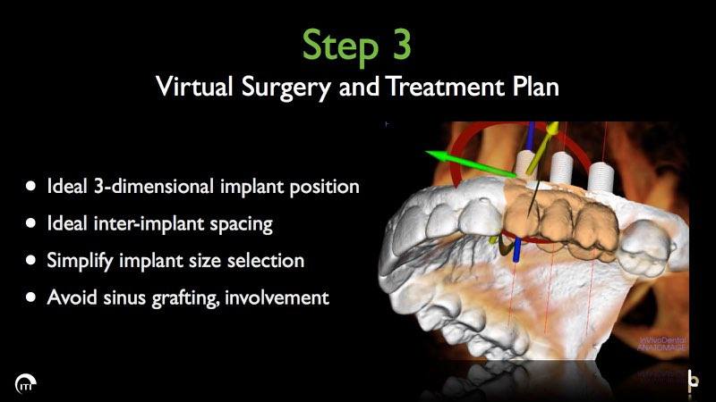 3 D rendering of tooth replacement plan