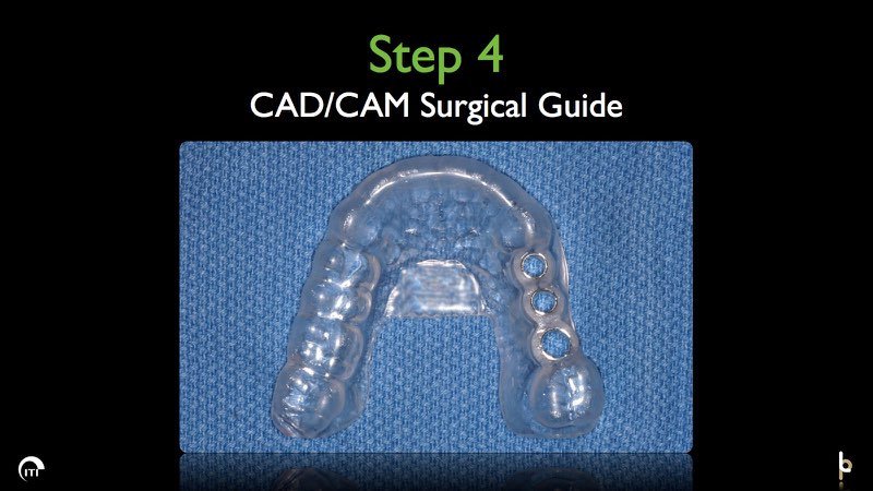 Plastic surgical guide tool