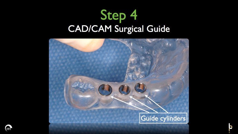 Surgical guide with arrow pointing to metal cylinders