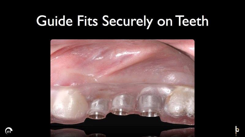 Smile with dental implant surgical guide in place