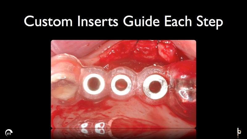 Smile during dental implant guided surgery