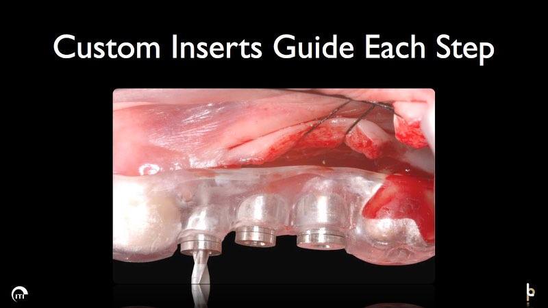 Working on placing dental implant post with surgical guide in place