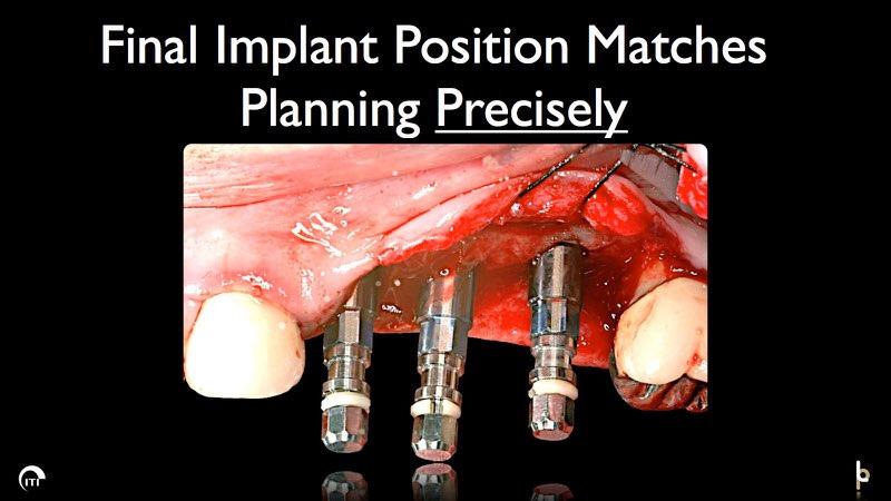 Dental implant posts in place in the gum line