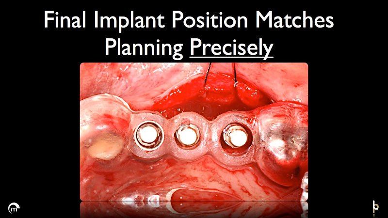 View looking down on three newly positioned dental implant posts