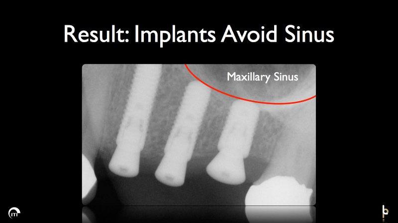 X-ray of dental implant posts in the gum line