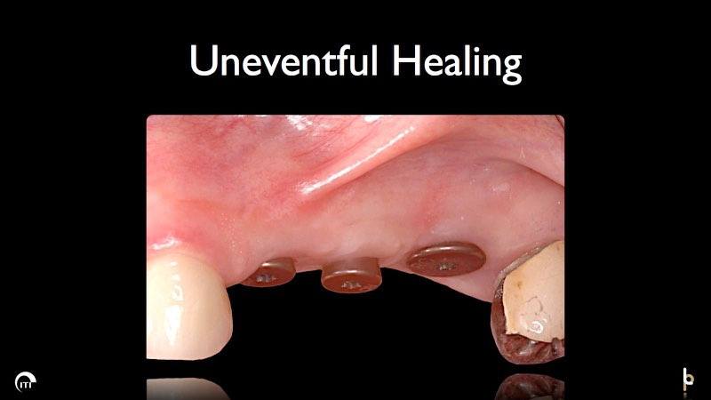 Dental implant posts visible in gum line after healing