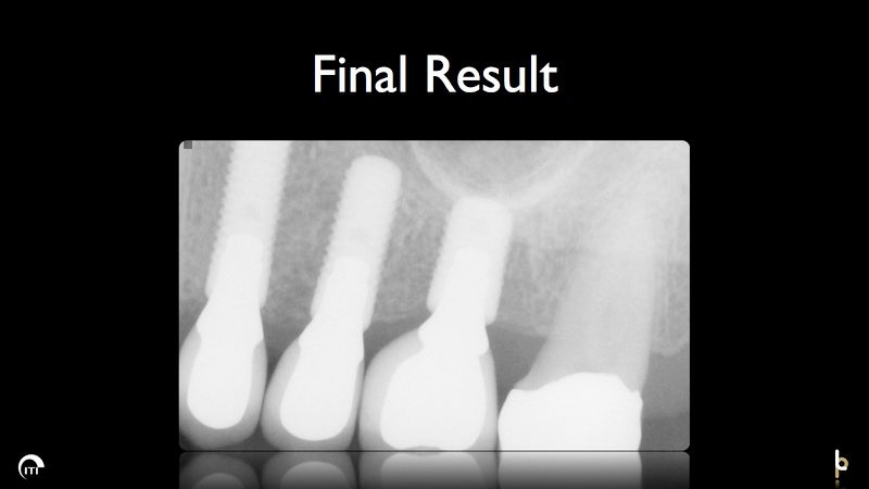 X-ray of flawlessly restored smile