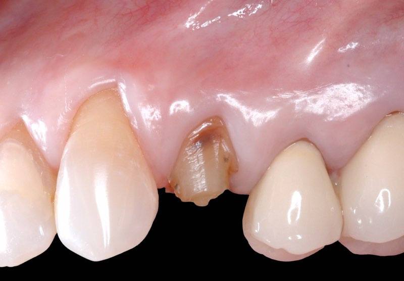 Smile with severely damaged tooth
