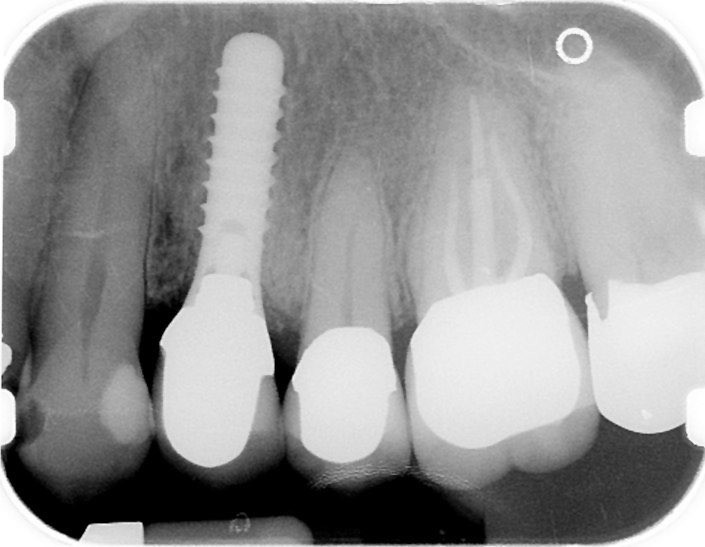 X-ray of dental implant supported dental crown