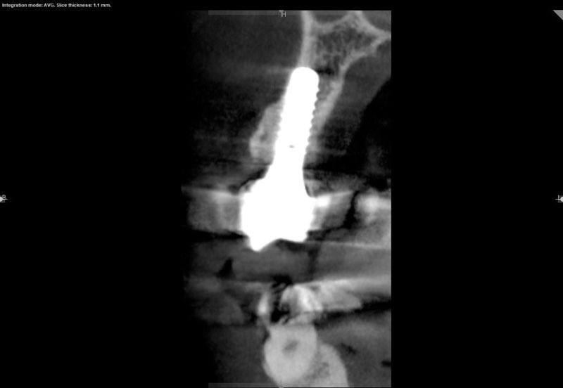 C B C T scan of dental implant 11 years after placement
