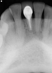 X-ray of tooth with severe damage