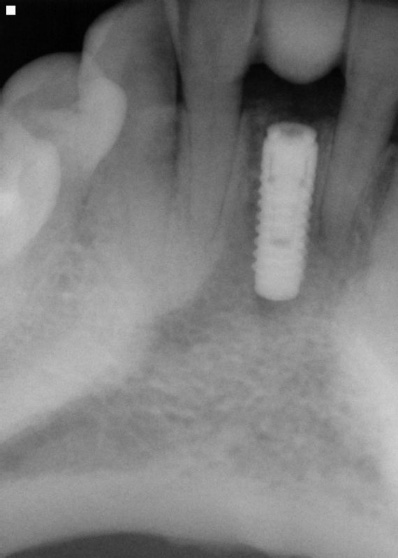 X-ray of smile with dental implant post in place