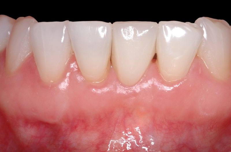 Flawless smile after dental implant tooth replacement