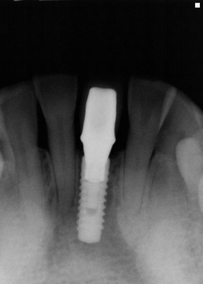 X-ray of dental implant post and abutment