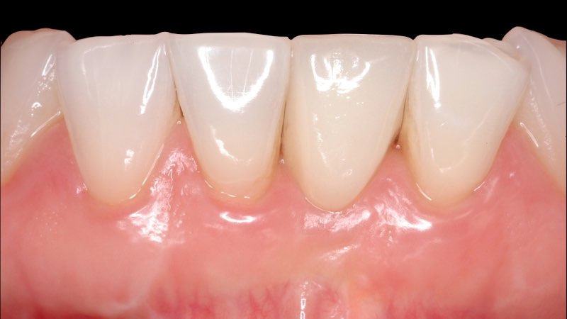 Flawless smile several years after dental implant restoration