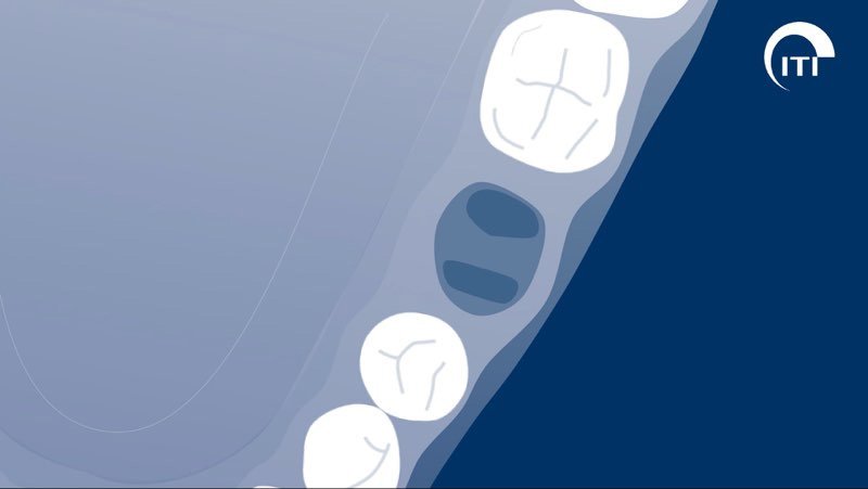 Animated 3 D rendering of minimally traumatic tooth extraction