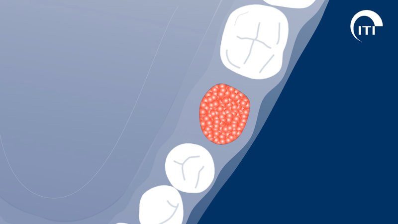 Animated 3 D rendering of bone graft