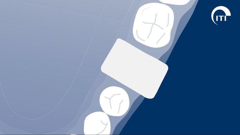 Animated 3 D rendering of cytoplast membrane placement