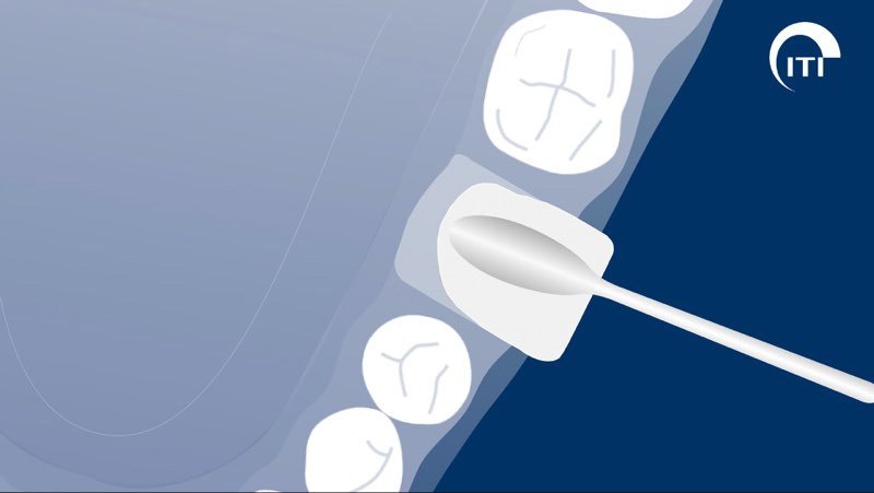 Animated 3 D rendering of membrane tucked below tum tissue