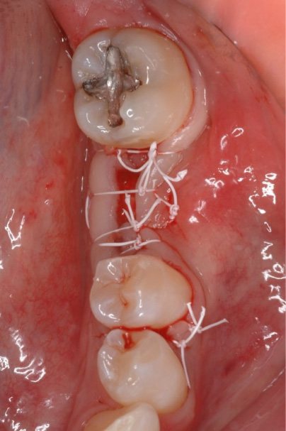 Gum tissue stitched after membrane placement
