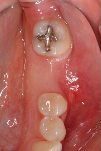 Healed tissue after membrane tissue