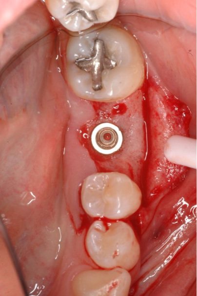Gum tissue with dental implant visible