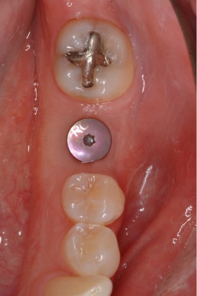Dental implant post visible in gum tissue