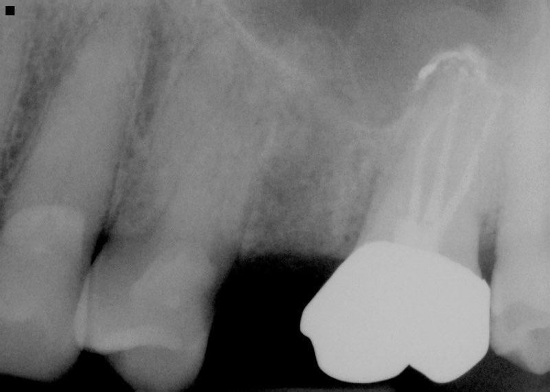 X-ray of smile after ridge preservation procedure