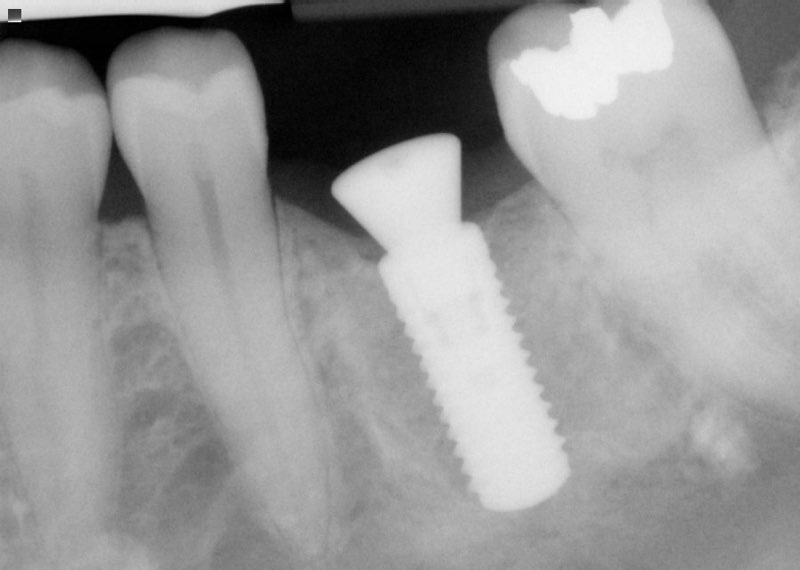 X-ray of dental implant post