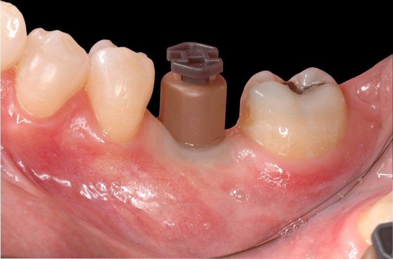 Impression cap over dental implant abutment