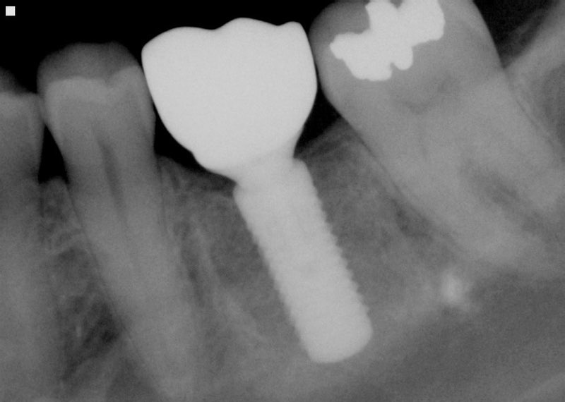 X-ray of dental implant supported replacement tooth