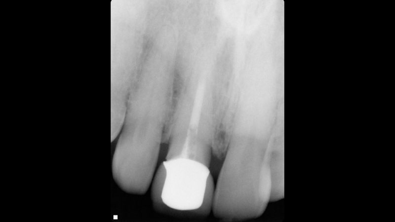 X-ray of tooth with severe fracture