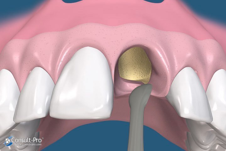 Animated smile with tissue shifted for membrane placement