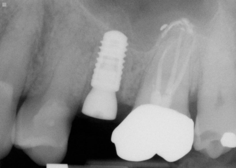 X-ray of smile with dental implant post in place