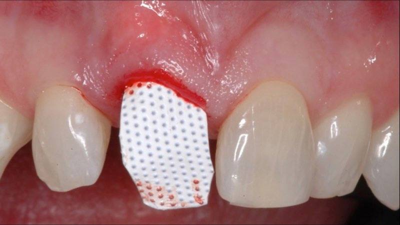 Smile with membrane in place