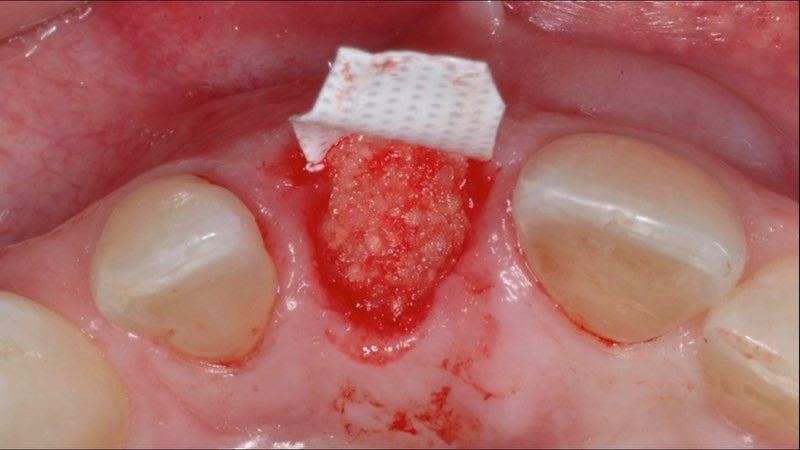 Gum tissue with membrane
