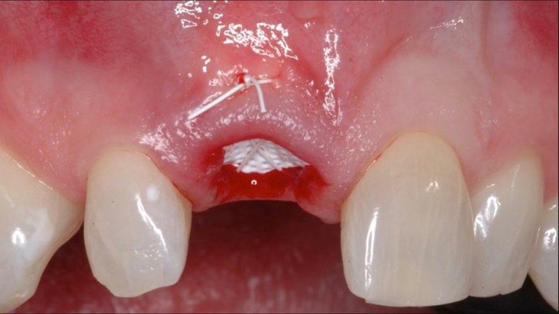 Gum tissue stitched over newly placed membrane