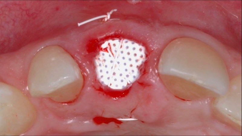 Top view of newly placed membrane