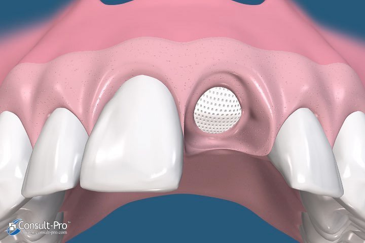 Animated gum tissue with membrane