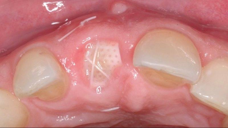 Gum tissue with membrane visible