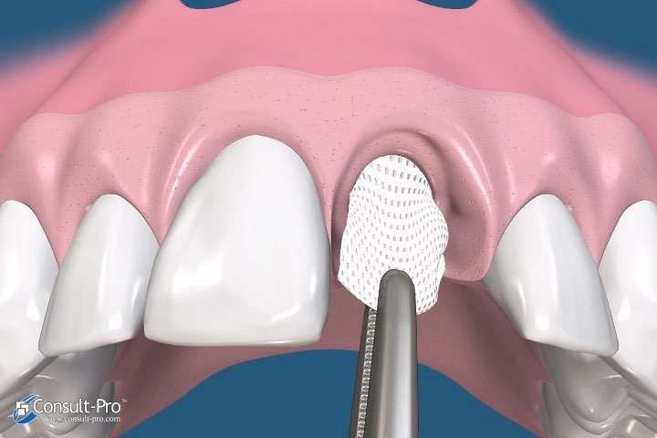 Animated membrane removal