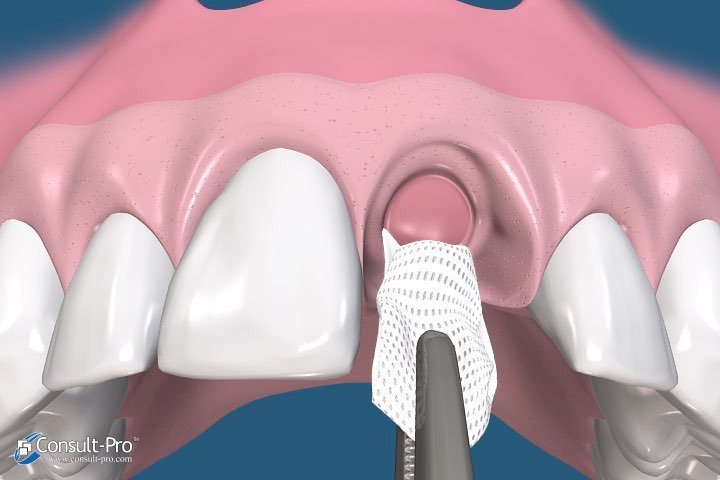 Animated membrane removal process