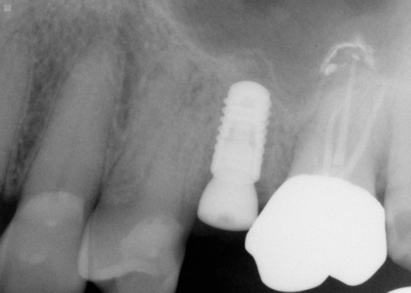 X-ray of dental implant post prior to restoration