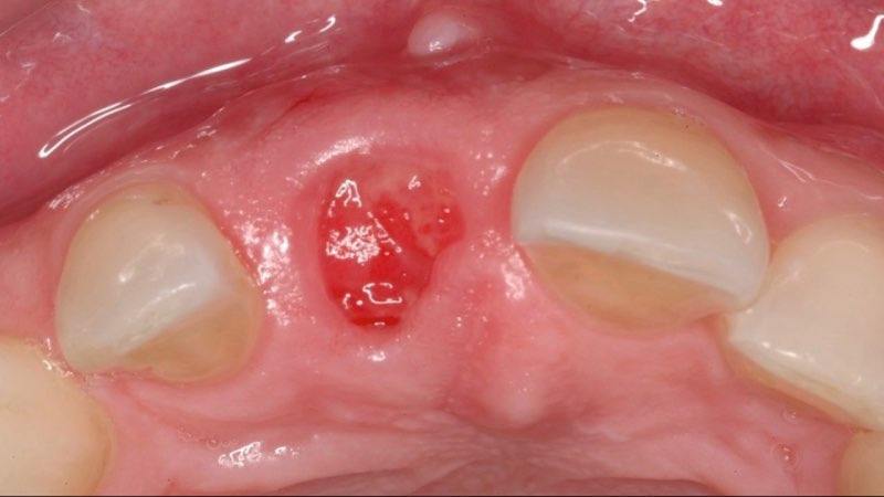 Gum tissue after membrane removal