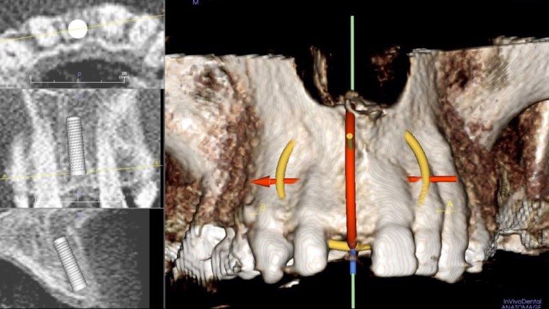 3 D Rendering of bone volume after membrane placement